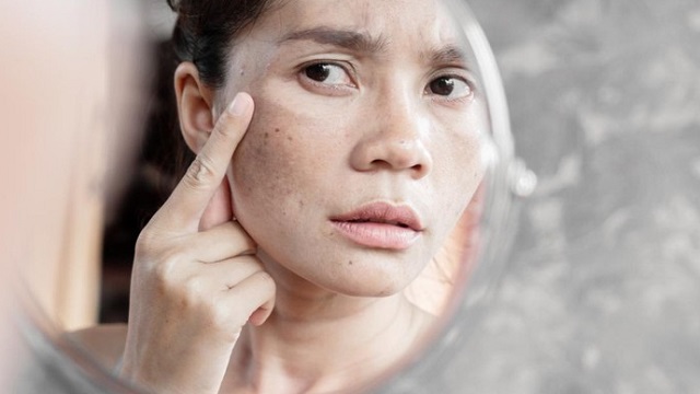 Tips Mencegah Munculnya Bintik Hitam di Wajah